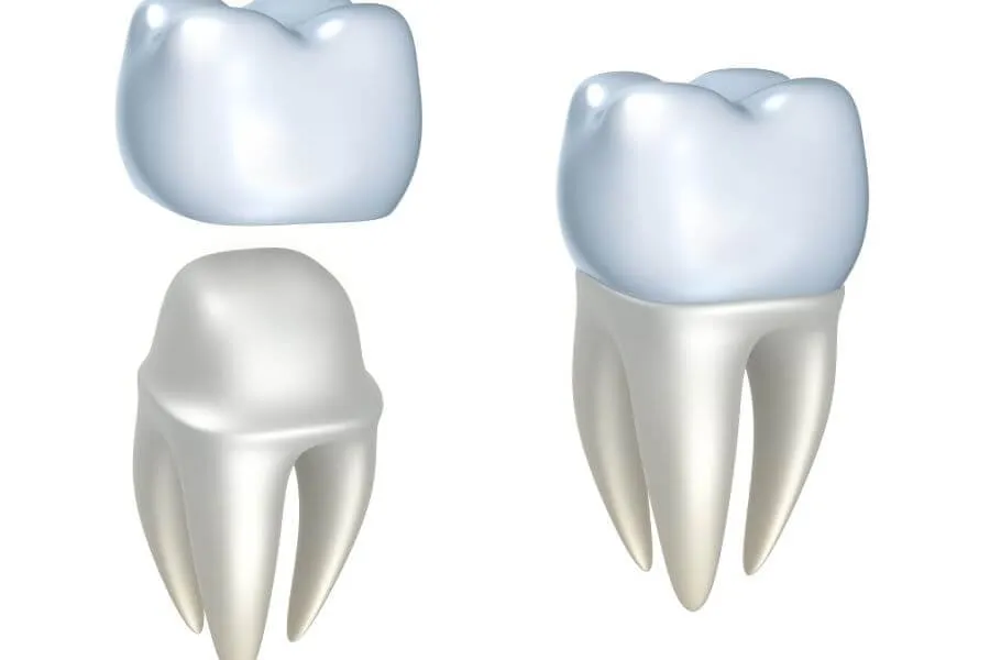 Dental Crowns Dentist in Weston General Dentistry Artisa Dental 954-928-9192