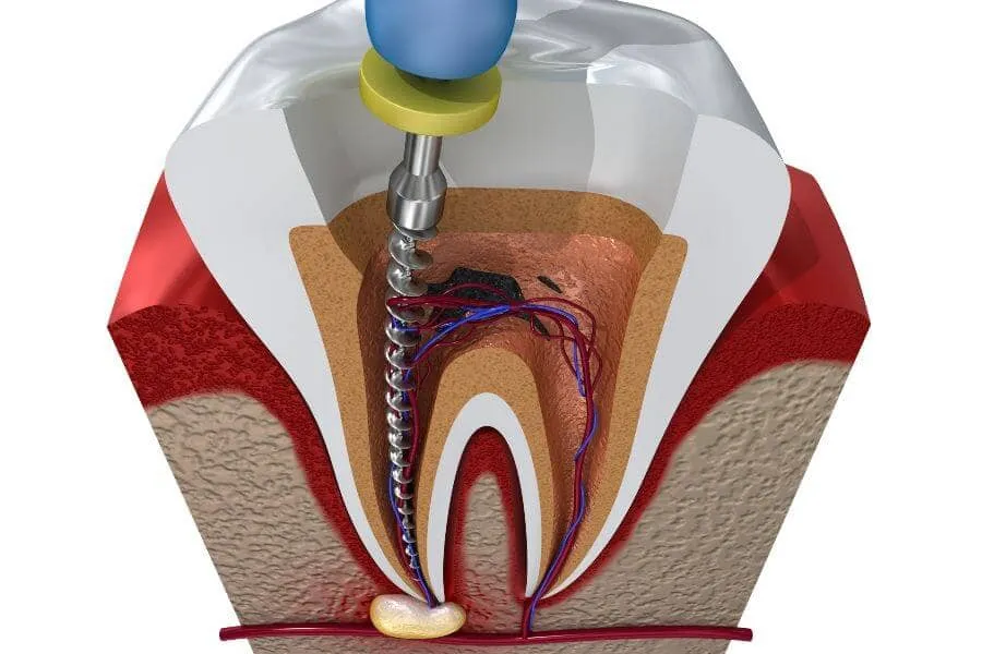 Root Canal Treatment in Bay Harbor Dentist in Bay Harbor General Dentistry Artisa Dental (305) 861-9200