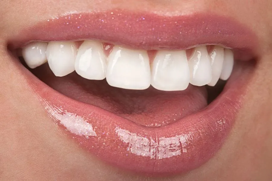 Veneers in Bay Harbor Dentist in Bay Harbor General Dentistry services Artisa Dental (305) 861-9200