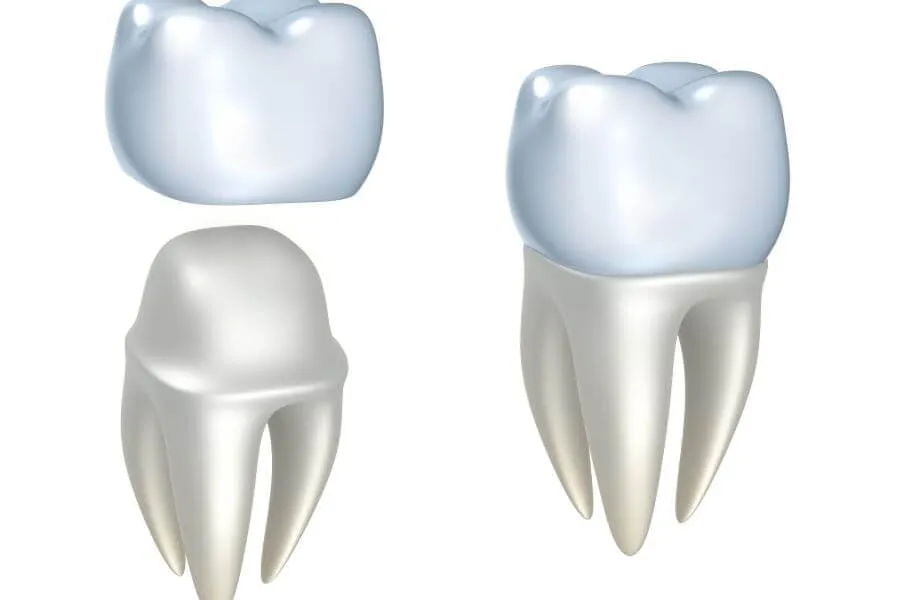 Dental Crowns Dentist in Plantation General Dentistry Artisa Dental 754-755-6350