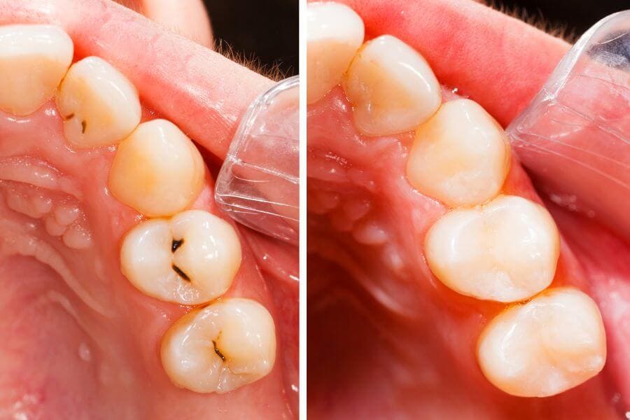 Dental Fillings - Dentist in Weston General Dentistry Artisa Dental 954-928-9192