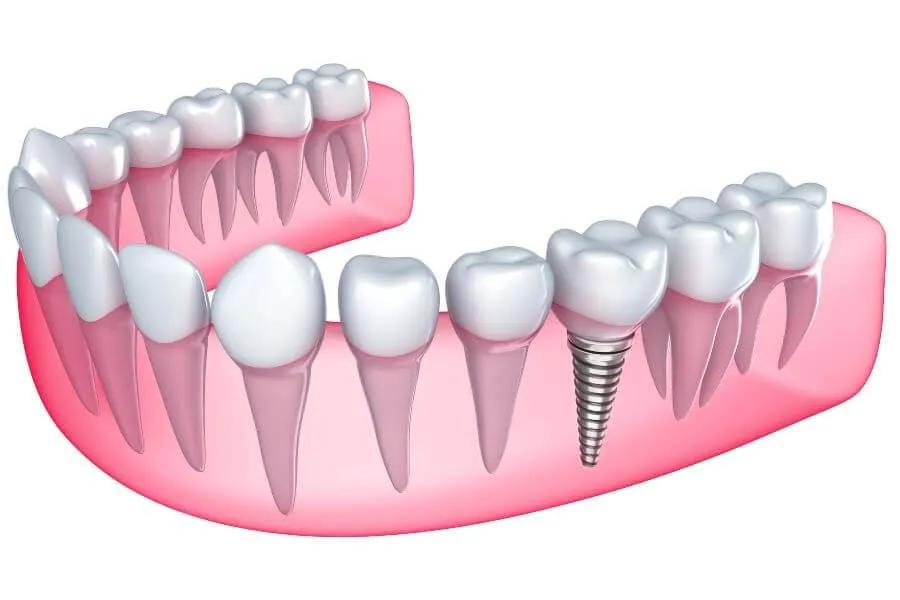 Dental Implants in Weston General Dentistry Artisa Dental 954-928-9192