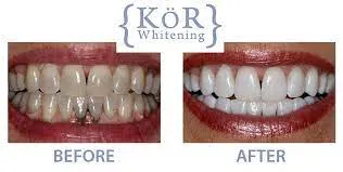 whitening in Weston Dentist in Weston General Dentistry services Artisa Dental 954-928-9192